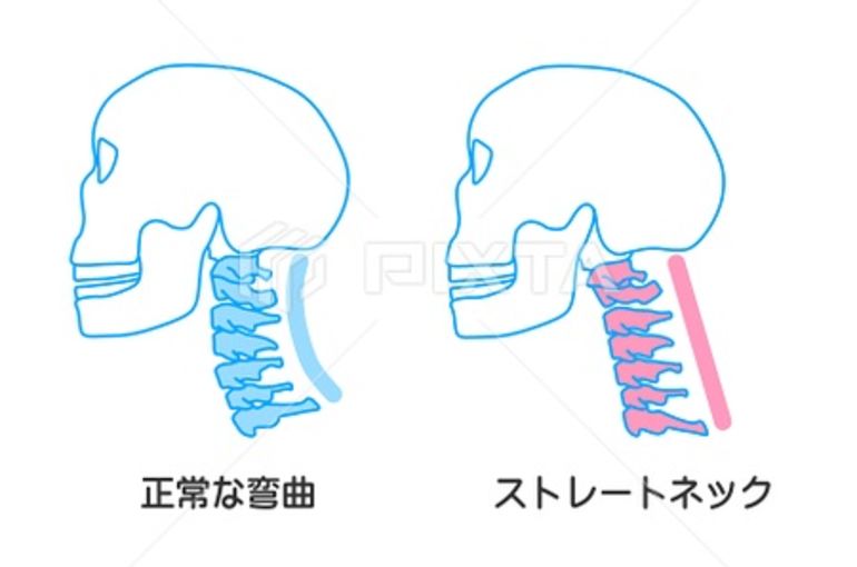 ストレートネック